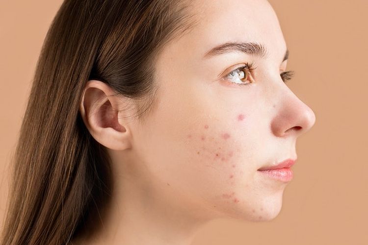 7 Produk Skincare yang Bisa Bantu Kamu Atasi Jerawat Bandel_banner